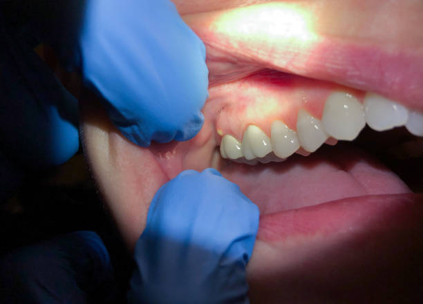 Best Emergency Tooth Extraction in Cumberland Center, ME